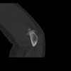 SPORK, NICO - 22.03.1976 - 02.08.2022 - CT obere Extremität - 18:01:46
